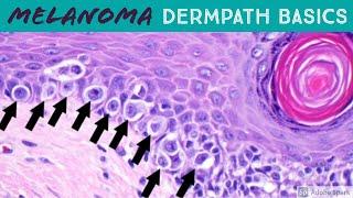 Melanoma vs Nevus: Microscopic Clues for Malignancy Explained in 5 Minutes