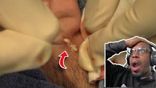 I HAVE NEVER SEEN AN EAR CYST LIKE THIS! | Inflamed Ear Cyst - Dr. Derm