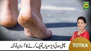 Zubaida Apa Totkay | How to Treat Cracked Ankles & Heels | Remove Quick Cracked Heels & Ankles