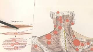 Триггерные точки - что это?