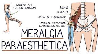 Meralgia paresthetica (also known as lateral femoral cutaneous nerve entrapment) | Drk