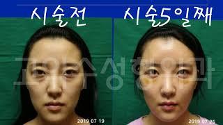 햠의 다크일기4.  다크서클 시술 후 6일 째 멍과 붓기를 확인하세요.