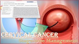 Cervical Cancer stage wise Management