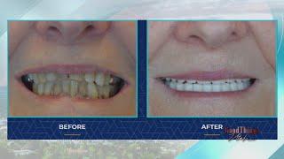 ClearChoice Dental producing amazing dental implant makeover results