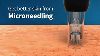 How Microneedling Improves Skin Firmness and Complexion (Collagen Induction Therapy)