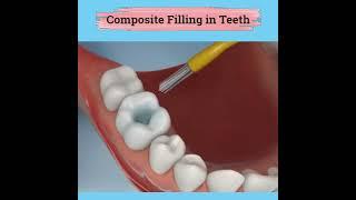 Composite Filling in Teeth Process | Dr. Kinjal Patel Pediatric Dentist | Best Pediatric Dentist
