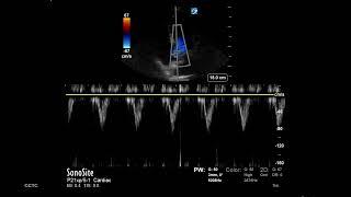 How to... Measure LVOT VTI