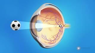 What are cataracts?