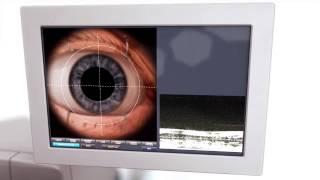 Bladeless Laser Cataract Surgery in Bradenton & Sarasota – The Eye Associates