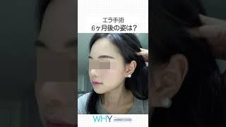 エラ手術から6ヶ月が経つと？