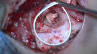 Microtia atresia ear canal reconstruction