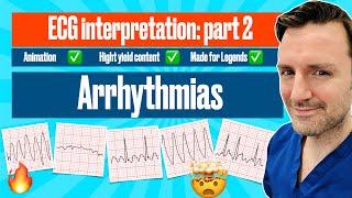 Arrhythmias: A Visual Guide with ECG Criteria #ecgmadeeasy