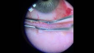 Meibomian Gland Expression (Upper and Lower Lid)