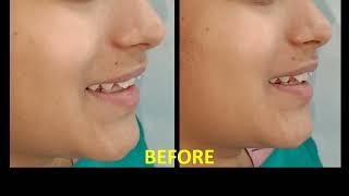 BRACES IN DELHI- BEST & ECONOMICAL, Metal Braces are Cheap and work well too. BANDHU DENTAL CLINIC