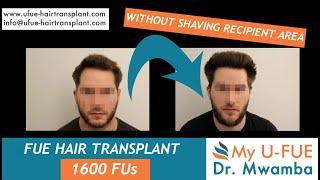 Hairtransplant without shaving recipient | FUE | 1600 FUs | Dr. Patrick Mwamba WHTC Brussels Belgium