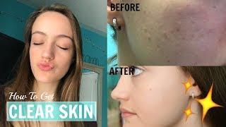 How to Get CLEAR Skin! What my Dermatologist Told me || Acne Tips that WORK