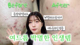 [Skincare] 광고 여드름 4년간 쌩고생하며 찾은 피부광명템 추천 모음.zip │ 좁쌀여드름박멸템, 여드름싹잡은앰플,핵쉬운각질제거제추천, 여드름스팟케어추천