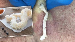 Gritty Tripe-Like Cyst Squeezed Out | CONTOUR DERMATOLOGY