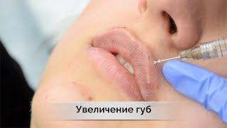 Увеличение губ или контурная пластика | филлеры  juvederm в Самаре   влог