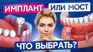 Что лучше – имплант или мост? Разбираем плюсы и минусы каждого метода