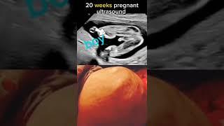 20 week pregnancy ultrasound scan it's a boy #baby #ultrasound