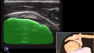 3D Cómo hacer: Examen ecográfico del tendón subescapular - Ecógrafo de SonoSite