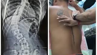 Scoliosis Best Treatment in India by DrRavi