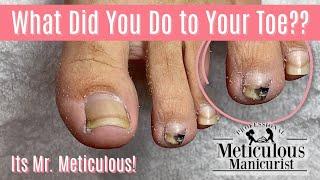 Its Mr. Meticulous!! - How to Pedicure an Ingrown & Impacted Toenail Pain