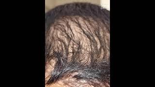 medispa failed hair transplant