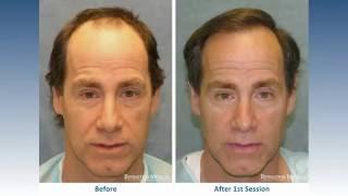 Hair Transplant Before and After: Bernstein Medical Patient AKL