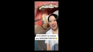 MUST you extract your Wisdom Tooth?  Here's the answer!  #shorts