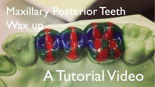 Maxillary posterior teeth - Wax up