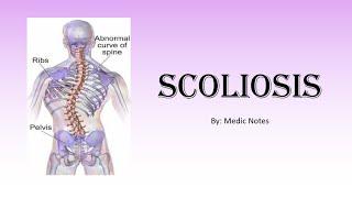 [Ortho] Scoliosis - postural & structural, Cobb's angle, Risser's sign, treatment