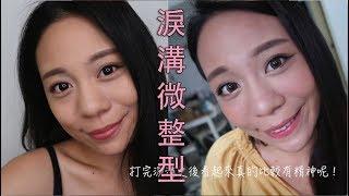 【裴你變漂亮】我的淚溝微整型｜彥靚診所