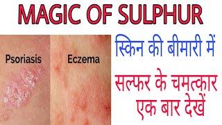 Best homeopathic medicine for skin | Qualities of  Sulphur | सल्फर | सल्फर के गुण ।