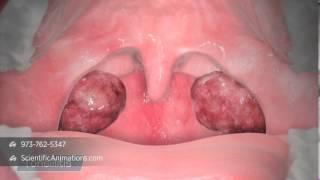 3D Medical Illustration of Tonsils - Tonsillitis Animation | ENT Animation