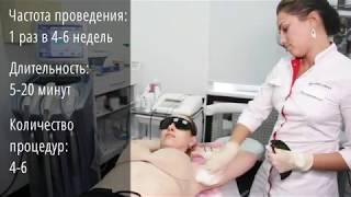 Лазерная эпиляция подмышек