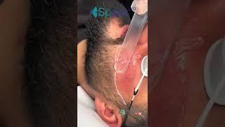 Nie mehr Wangen- und Hals-Haare!  Dauerhafte Laserhaarentfernung mit Spark Pro!