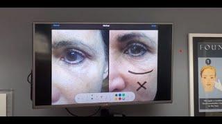 Agnes Chicago | New treatment to help wrinkle under the eyes | Dr. Kovak Oak Brook Rockford Chicago