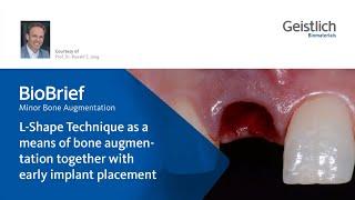 L-Shape Technique as a means of bone augmentation together with early implant placement