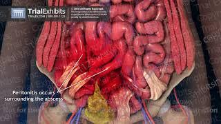 Delayed Post-operative Bowel Perforation with Resulting Septic Shock