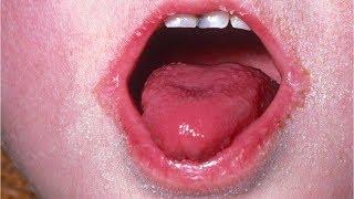 What is scarlet fever?