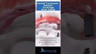 Dental Treatment; İmplant + Curatage + Root Canal #dentaltreatment #hollywoodsmile