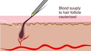 Electrolysis for hair removal