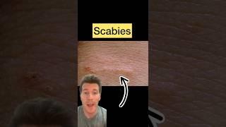 Doctor explains SCABIES in 60 seconds - causes, symptoms, treatment #shorts #scabies #health