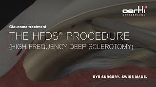 Spotlight: The HFDS procedure | Glaucoma treatment