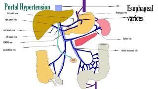 Portal hypertension video