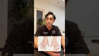 Are bulging hand veins a medical issue?