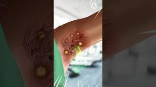 ASMR infected underarms cleaning treatment  #asmr #animation #hindiversion #viral #shorts