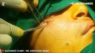 Maxilla Fat Grafting Surgery in Surat - Live Video